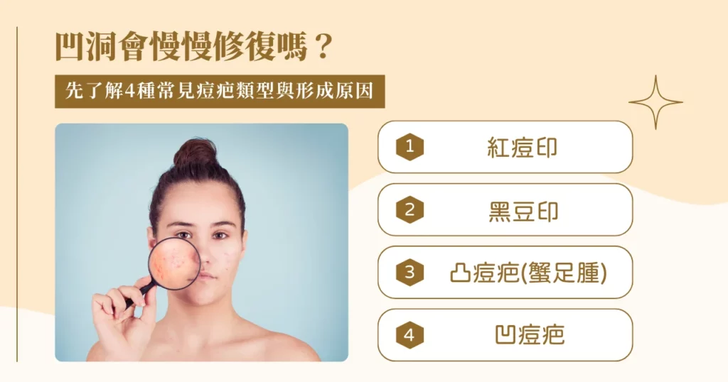 凹洞會慢慢修復嗎？先了解 4 種常見痘疤類型與形成原因
