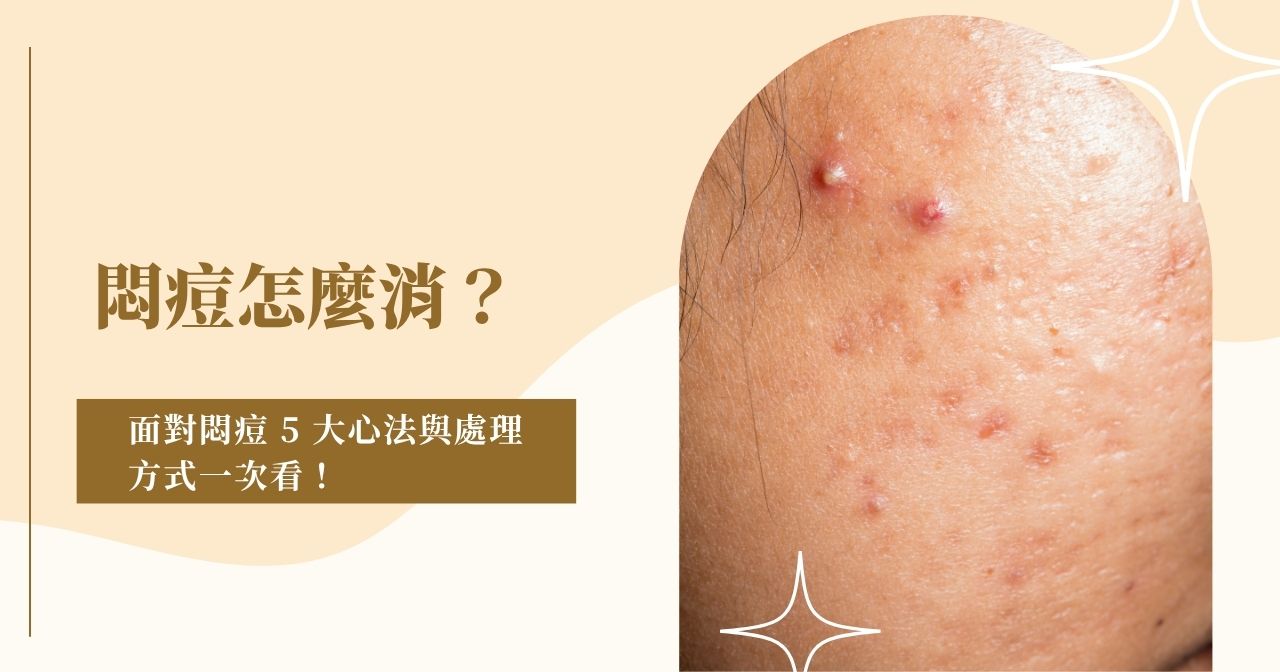 悶痘怎麼消？面對悶痘 5 大心法與處理方式一次看！